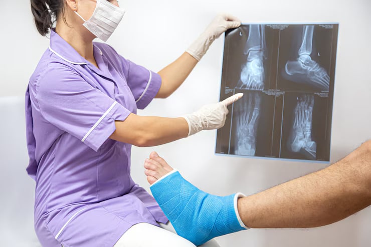 Common Car Accident Injuries: Broken Bones / Fractures Image for Common Car Accident Injuries: Broken Bones / Fractures post