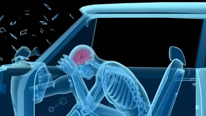 Image for Common Car Accident Injuries: Traumatic Brain Injuries post